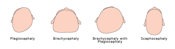 plagiocephaly