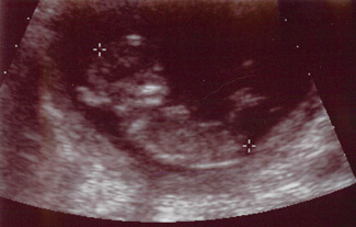 2012-01-06ultrasound