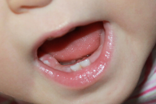 2013-06-28unexpectedmolar